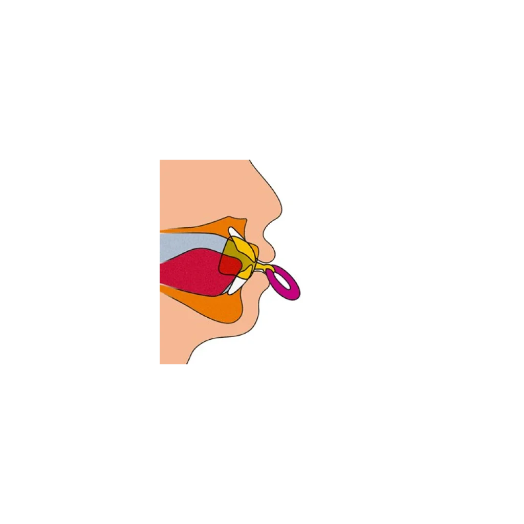 Muppy Oral Vestibular Plate in Use β How teeth correction works Child with Muppy oral vestibular plate β Supports natural teeth alignment