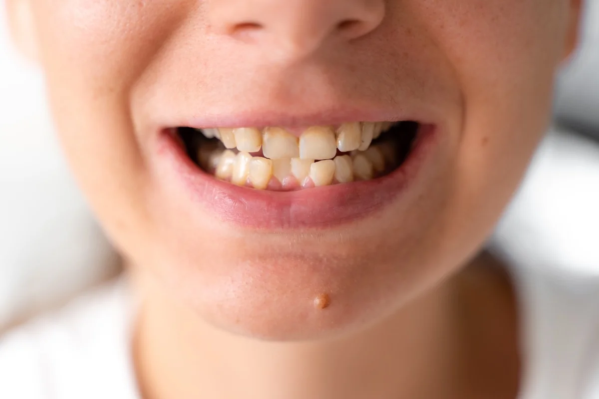Logicana-Zahnfehlstellung-zungenruhelage-mundatmung-nasenatmung